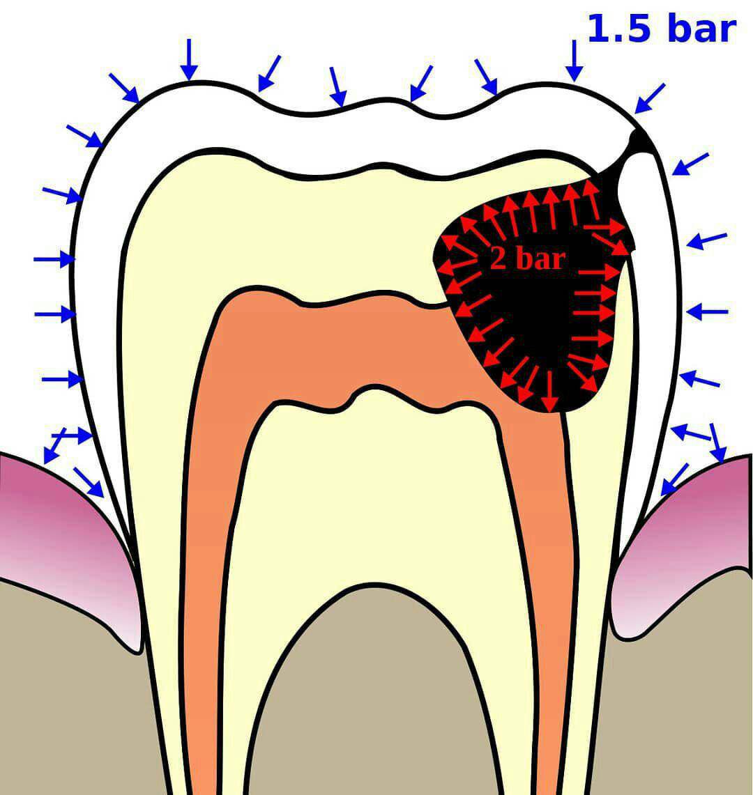 تاثیر ارتفاع بر دندان‌ و درد دندان - 