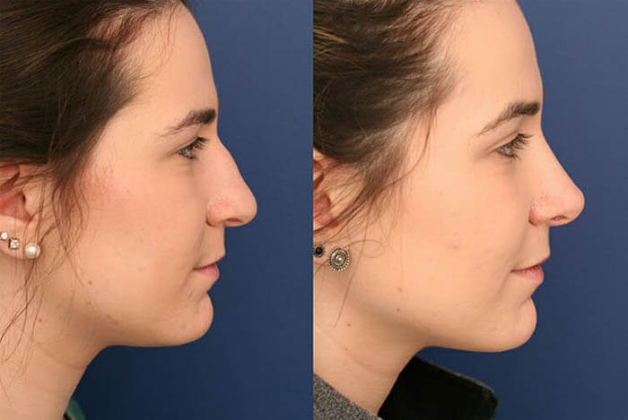 What Is Cosmetic Nose Surgery? - 