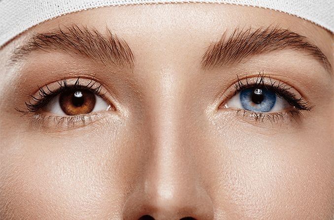 What Is Eye Color Change Surgery Or Iris Implant Surgery? 
